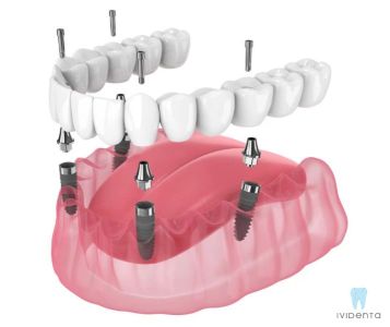Dantų implantai, dantų implantavimas, protezavimas ant implantų, nepažeidžiant greta esančių sveikų dantų