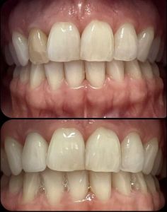 protezavimas Cirkonio vainikėliu Gargždai