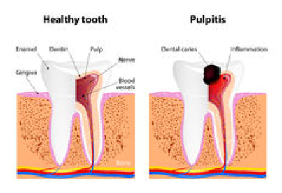 Endodontinis gydymas Jeruzalėje, Vilniuje